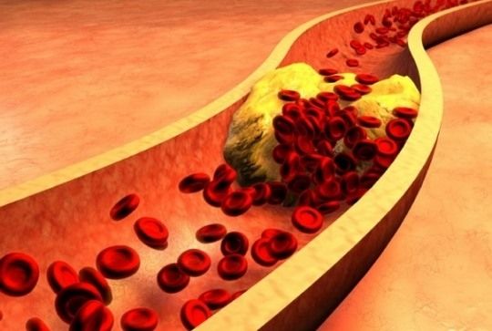 (사진) 고지혈증은 혈중 지질이 어느 수준 이상 높아 동맥경화성 심활관 질환이 일어날 수 있는 위험이 높은 상태를 말한다